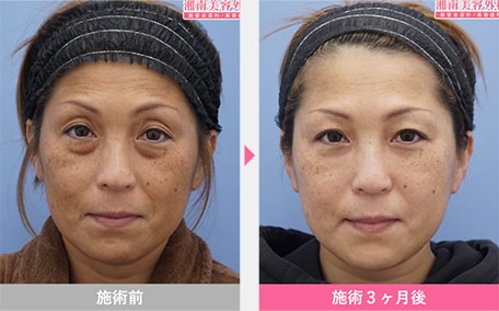 目の下の切らないクマ取り・たるみ（ふくらみ）取り 症例写真