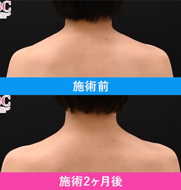 PICKUP症例2