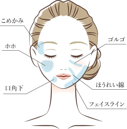 こめかみ ホホ 広角下 額 ゴルゴ ほうれい線 フェイスライン