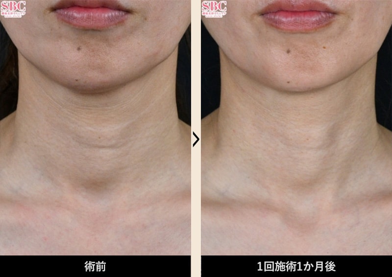 症例写真 Before After