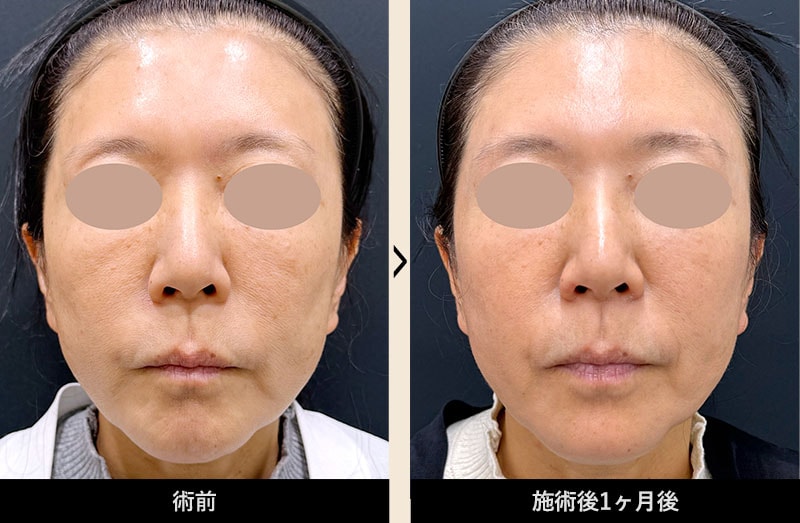 症例写真 Before After