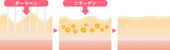 ダーマペンの仕組み