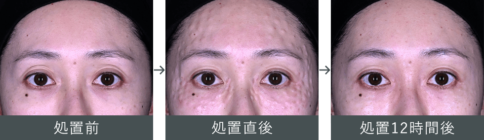 女優注射&reg;~リジュラン+ボトックス~ ダウンタイムの症例