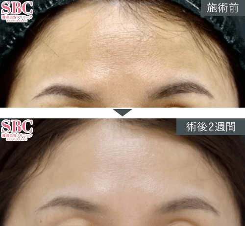 女優注射&reg;~リジュラン+ボトックス~症例写真（額）PICKUP1 Before After