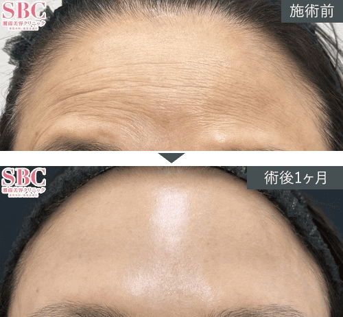 女優注射&reg;~リジュラン+ボトックス~症例写真（額）PICKUP2 Before After
