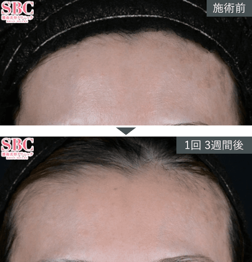 女優注射&reg;~リジュラン+ボトックス~症例写真（額）1 Before After