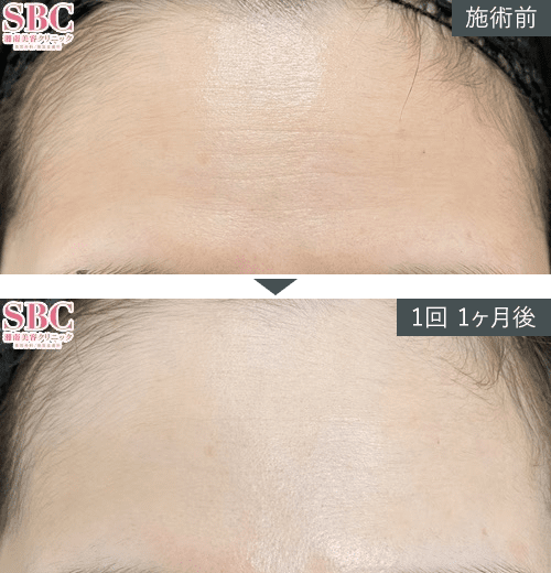 女優注射&reg;~リジュラン+ボトックス~症例写真（額）2 Before After