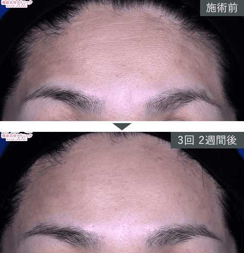 女優注射&reg;~リジュラン+ボトックス~症例写真（額）4 Before After