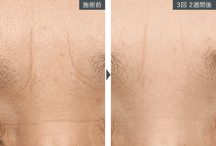 女優注射&reg;~リジュラン+ボトックス~症例写真（額）4 Before After