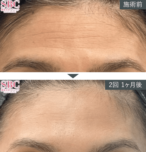 女優注射&reg;~リジュラン+ボトックス~症例写真（額）4 Before After