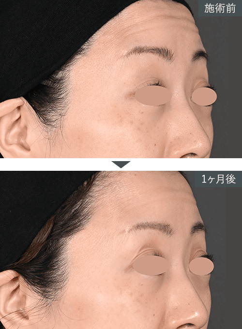 女優注射&reg;~リジュラン+ボトックス~症例写真（額） Before After