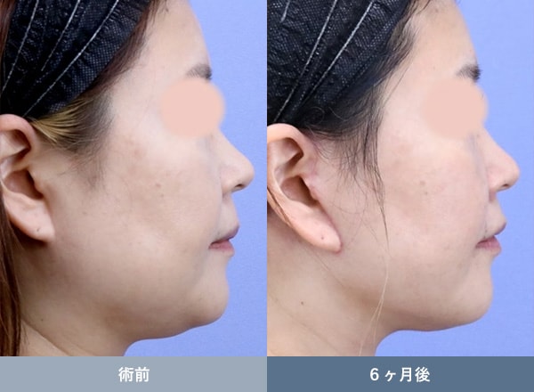 ネックリフトの症例写真01