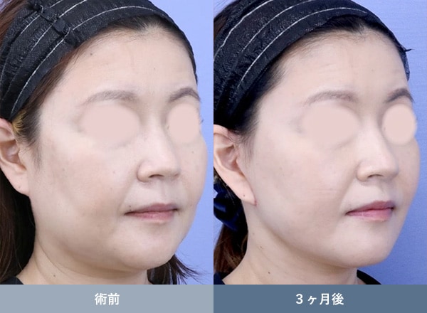 ネックリフトの症例写真02