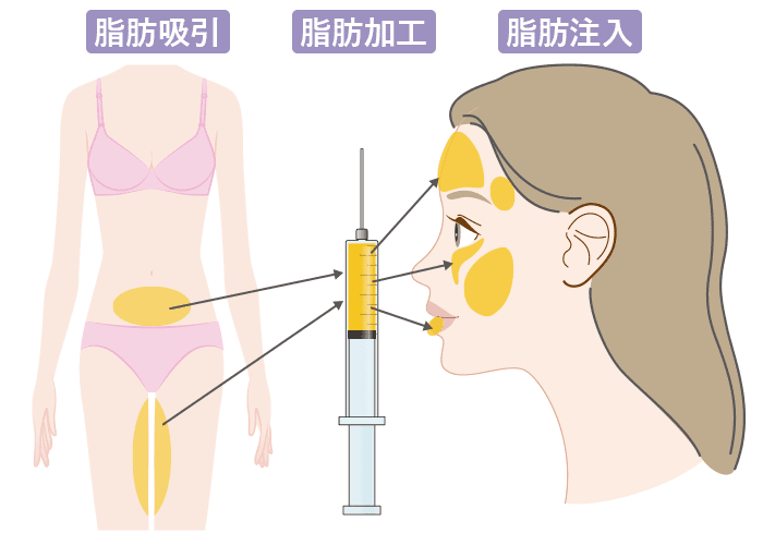 顔の脂肪注入とは