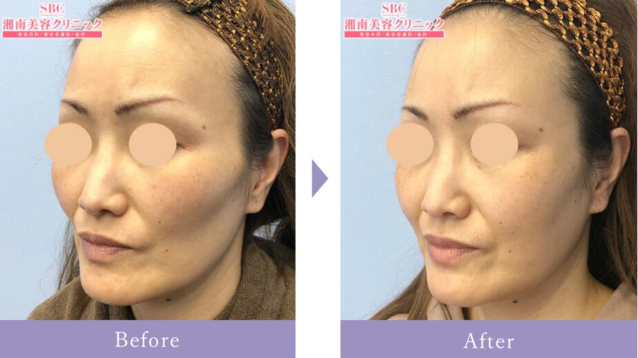 顔の脂肪注入で頬がふっくらとした症例