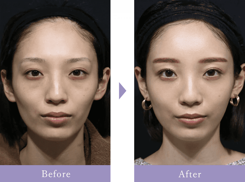 コンデンスリッチフェイス脂肪注入全顔入れ放題による顔のBefore After