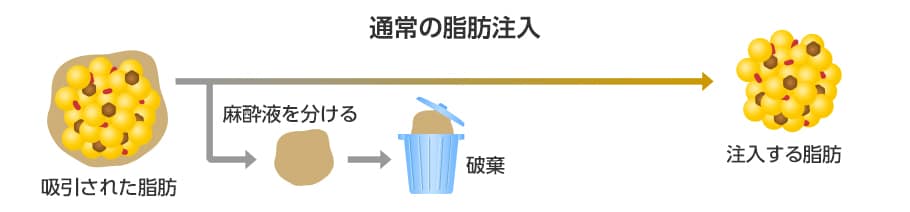 通常の脂肪注入の脂肪分離イメージ