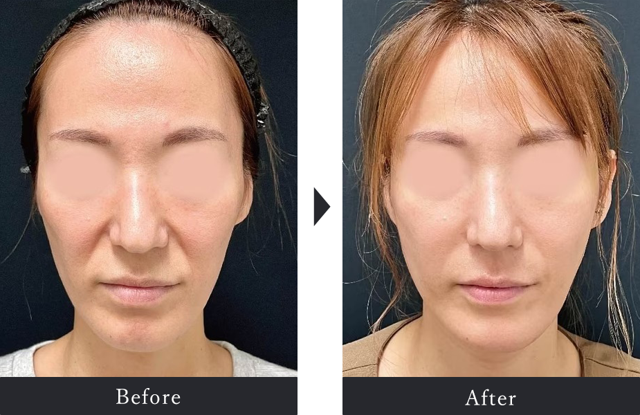 Before After