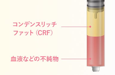 施術方法(CRF抽出)