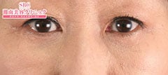 アイバックリムーブ症例写真5 After