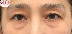 アイバックリムーブ症例写真2 Before