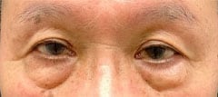 アイバックリムーブ症例写真6 Before