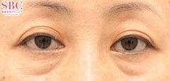 アイバックリムーブ症例写真4 Before