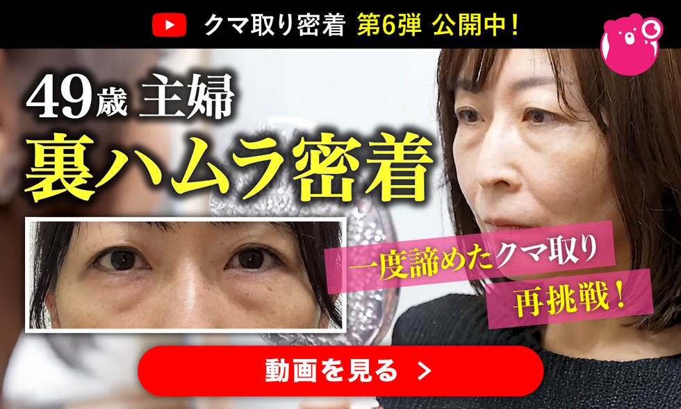 49歳一度諦めた整形…クリニック選びから手術後まで完全密着！