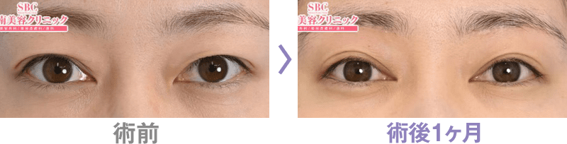 眉下リフト(眉下切開)の症例写真ビフォーアフター3