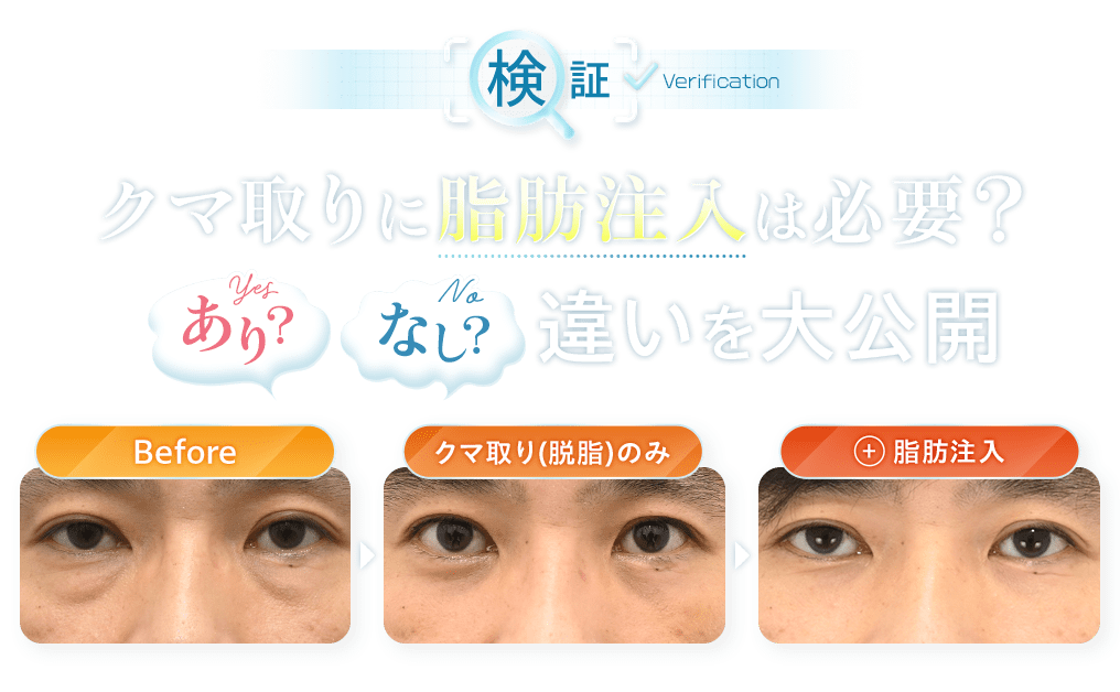 検証 クマ取りに脂肪注入は必要？あり？なし？違いを大公開