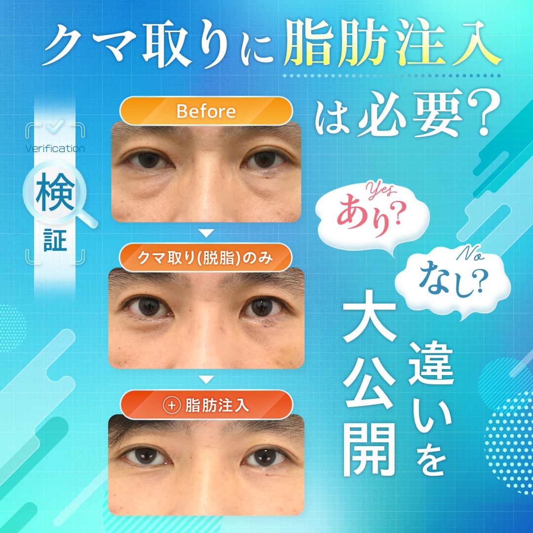 検証 クマ取りに脂肪注入は必要？あり？なし？違いを大公開