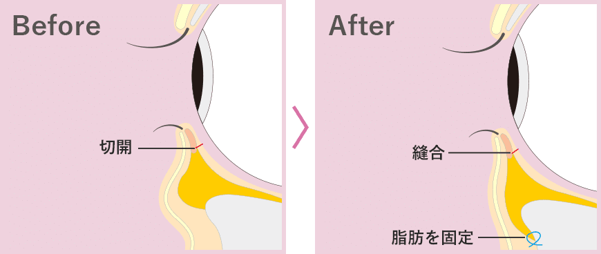 裏ハムラ法