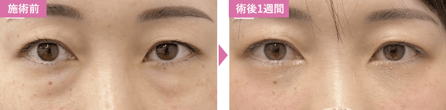 脱脂症例写真1