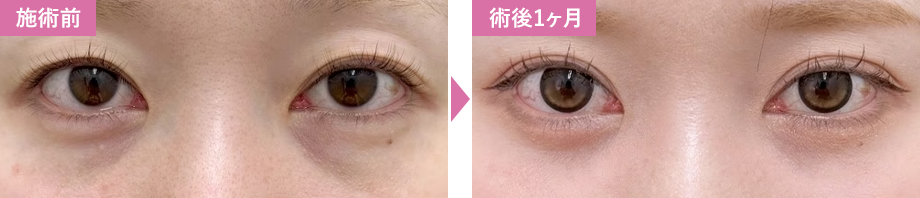 脱脂症例写真2
