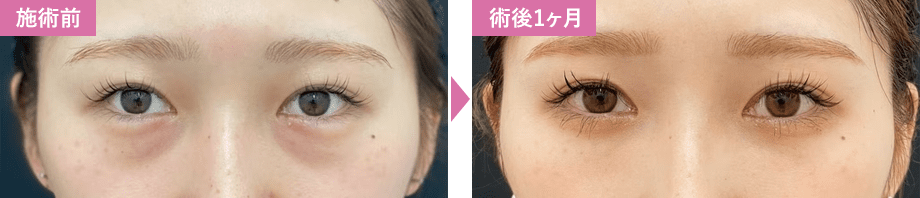 脱脂+脂肪注入症例写真1