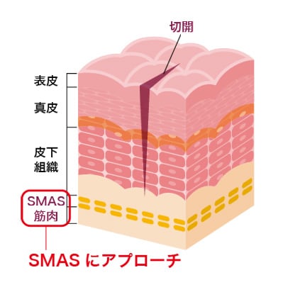 FEATURE SMASフェイスネックリフトの特徴