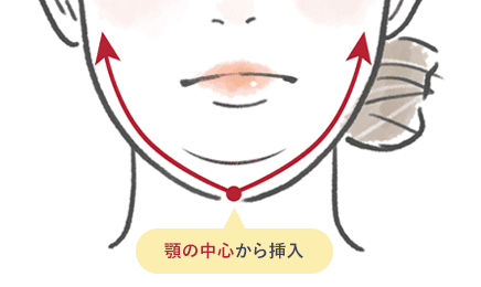顎下すっきリフト（アンカーDXダブル）と他の糸との違い イメージ1