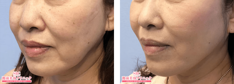 シークレットリフトのPickup症例写真2