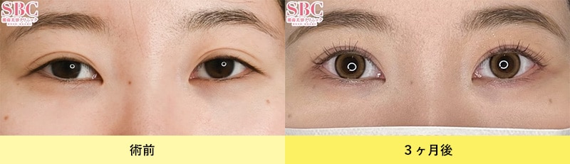 眼瞼下垂症例写真