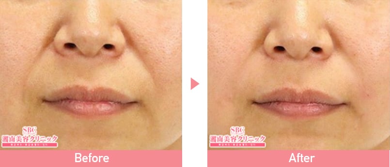 ジュビダームビスタ症例写真