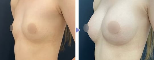 MESMO（メスモ）症例写真