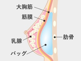 大胸筋下法