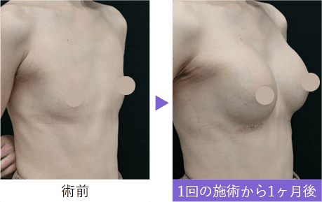【豊胸・バストの修正】豊胸インプラントバッグMESMO（メスモ）