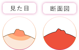 仮性陥没乳頭 (軽度)