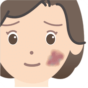 あざ、血管腫などの治療