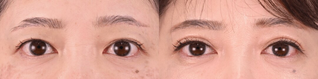 鼻整形のベスト症例写真