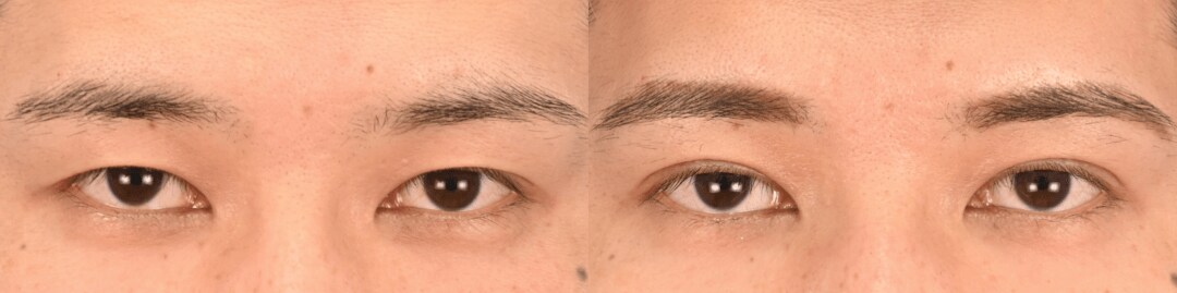 鼻整形のベスト症例写真