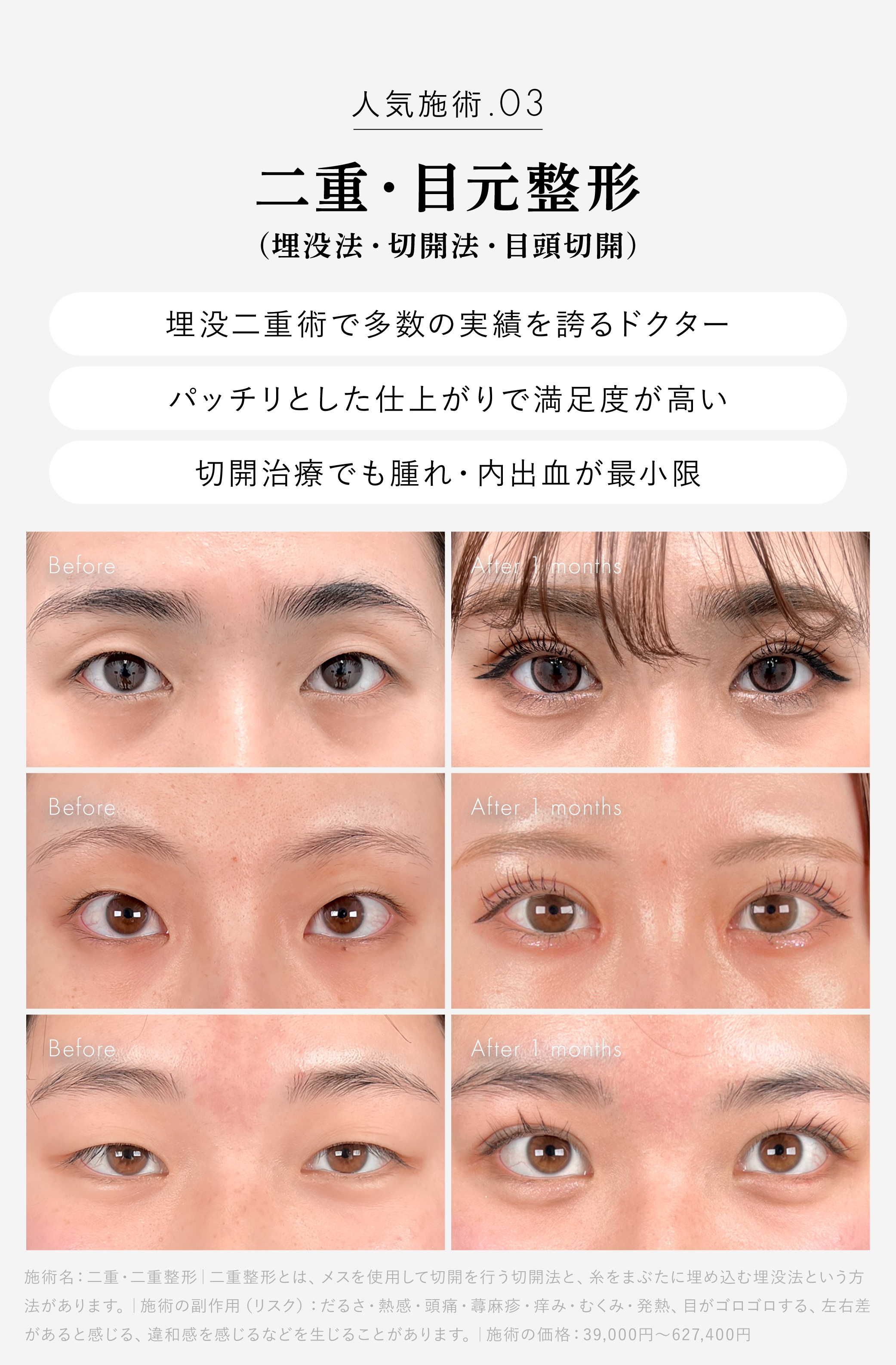 二重整形
