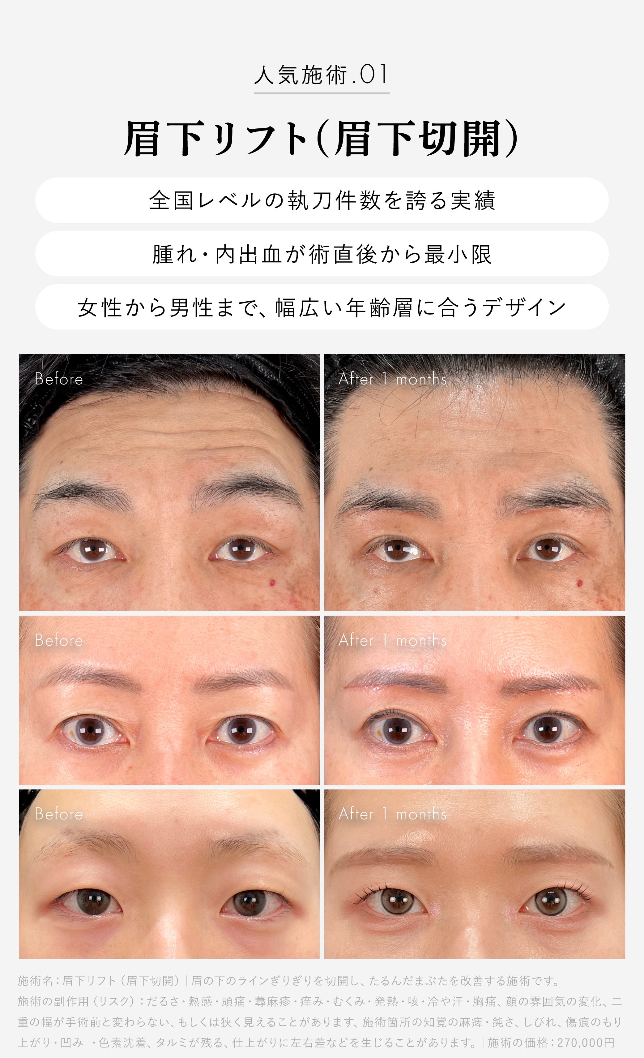 眉下リフト