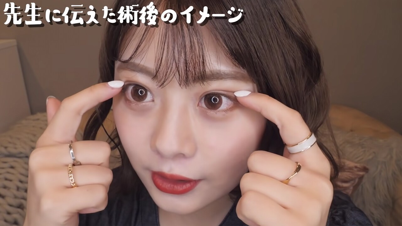 二重整形しました